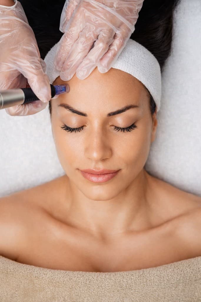 M-Pen Microneedling